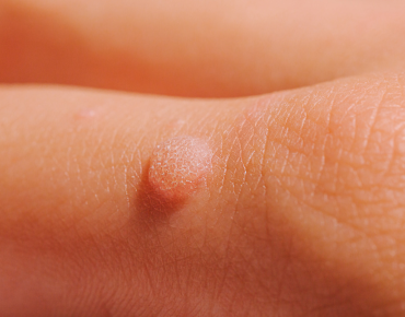 Tattoo Removal