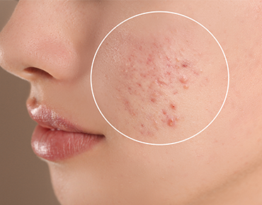 Acne & Scars Treatment
