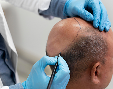 Hair Transplant
