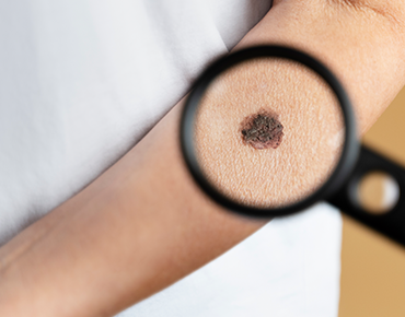 Mole Removal